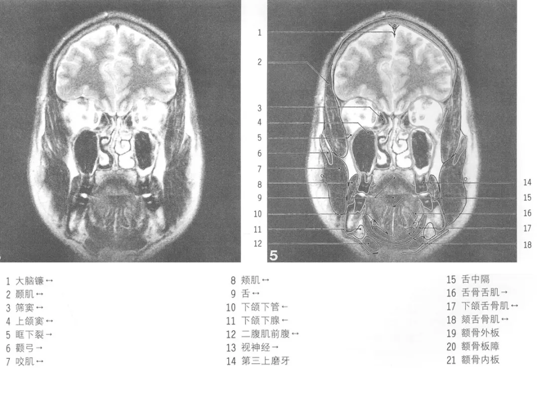影像基础:mri颅脑冠状位解剖图谱