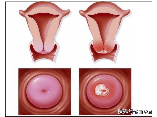 hpv是什么病毒图片_男hpv病毒是什么症状