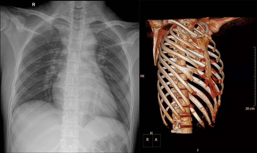 骨与关节先天发育疾患之67脊柱及胸廓畸形x线ct表现