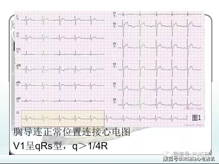 非心脏病的心电图异常