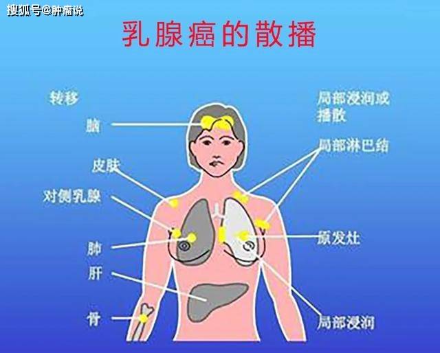 浸润性乳腺癌的肿瘤细胞通过血液运输到其他器官,在合适时机扎根在