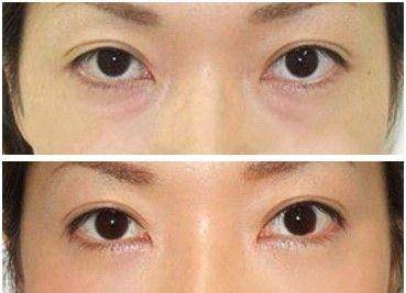 怎么快速去黑眼袋 90648bc80e6a485991ea5a3d2d173125.jpeg