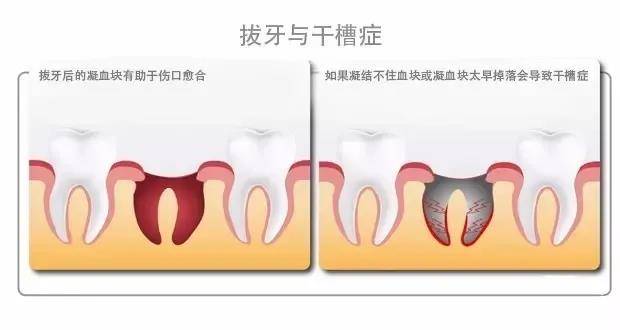 拔牙后流口水怎么办