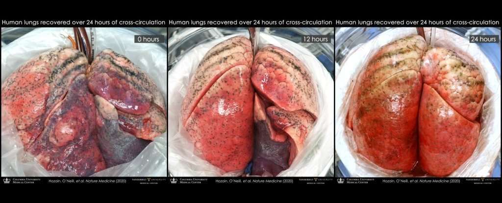实验显示受损的人类肺可以通过将它们附着在猪身上来修复