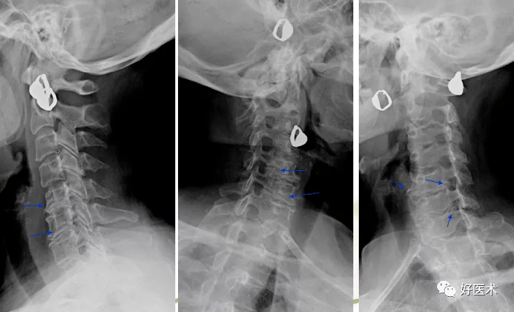 颈椎病解剖经典影像改变看这一篇就够了
