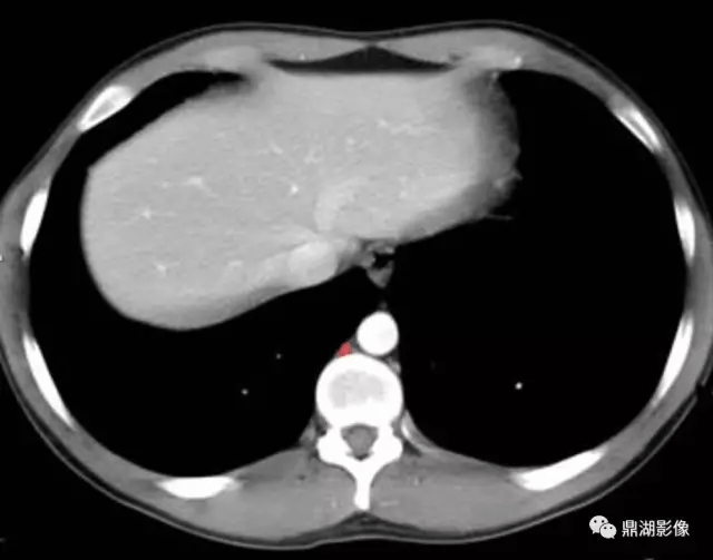 急症腹部ct:正常腹部断层解剖(一)