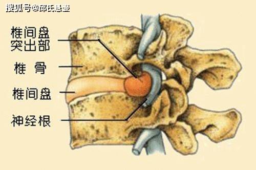 邱腰椎:预防腰椎间盘突出需要注意哪三点?后期应该做哪些锻炼?