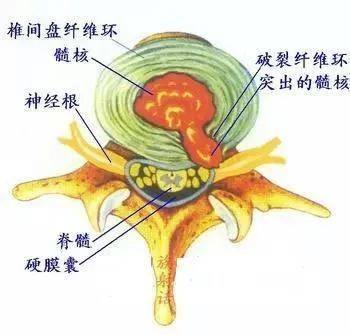 原因 颈椎退变,增生,刺激和压迫了颈神经根而引起的病症. 主要表现