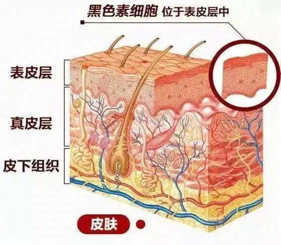 黑色素瘤:不是皮肤上一颗简单的"痣" 黑色素细胞位于人体表皮层中