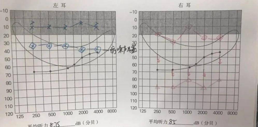 单耳聋干预|快来看看,哪种方法更适合自己(或家人)的听力?