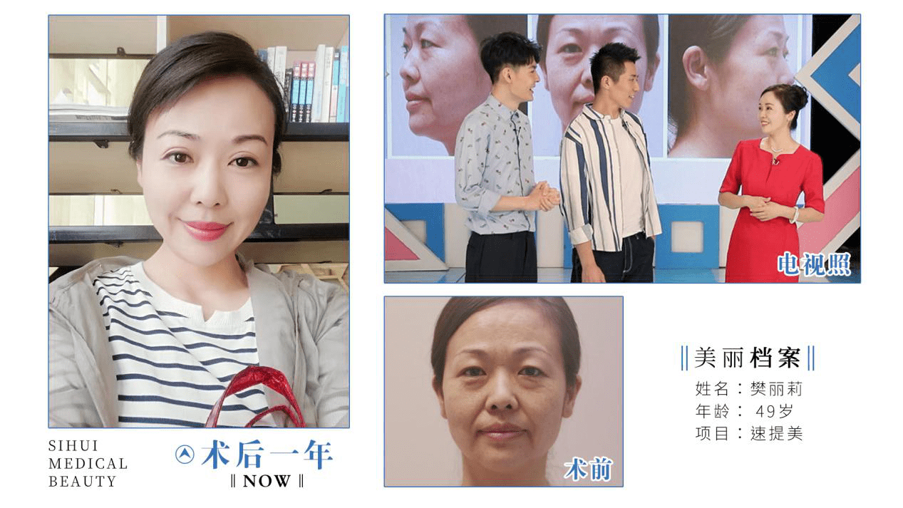 樊女士|四惠医美姚乃君主任速提美案例故事：女人打不垮，更要脸不垮