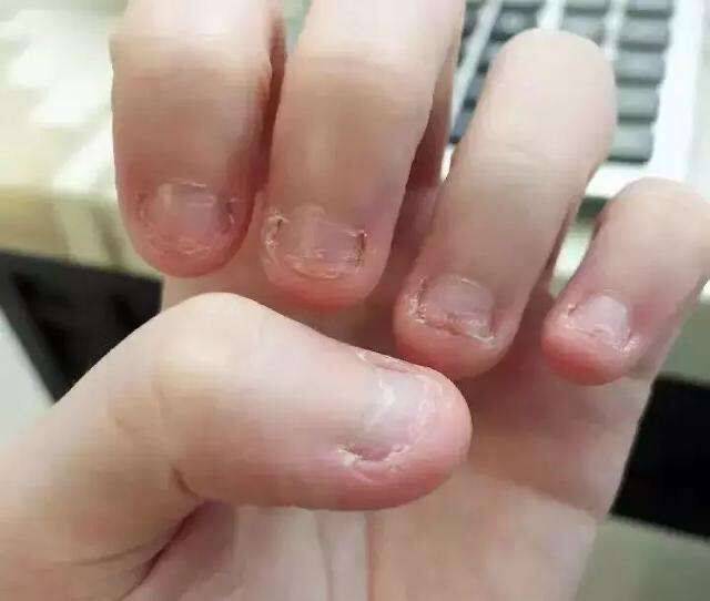 孩子手上长倒刺,是身体缺啥吗?原来通过手指可以看出这么多秘密