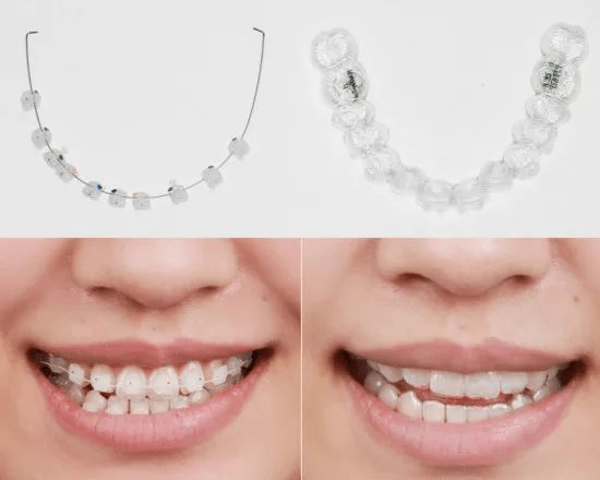 什么情况才需要拔牙 bcee9d751ba54a97ae8b9336efc48c5c.png