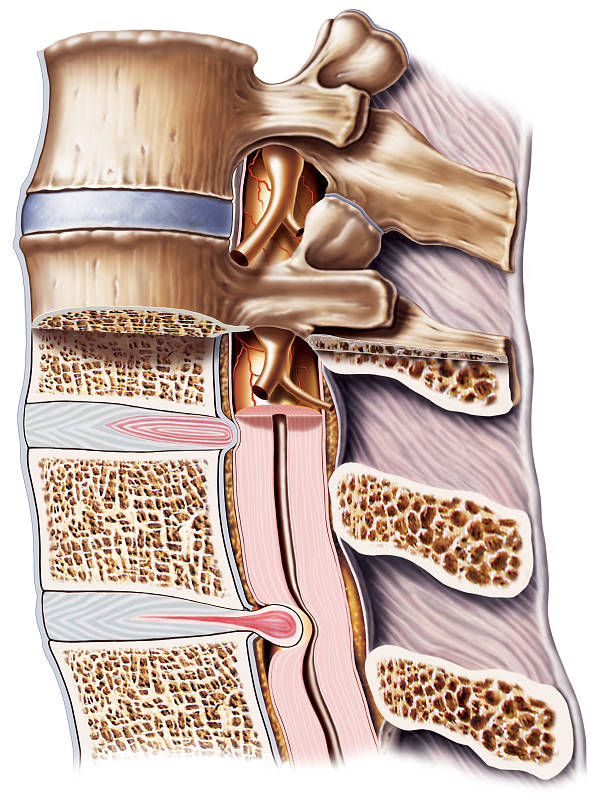 1,腰痛伴坐骨神经痛,是腰椎间盘突出症的主要症状.
