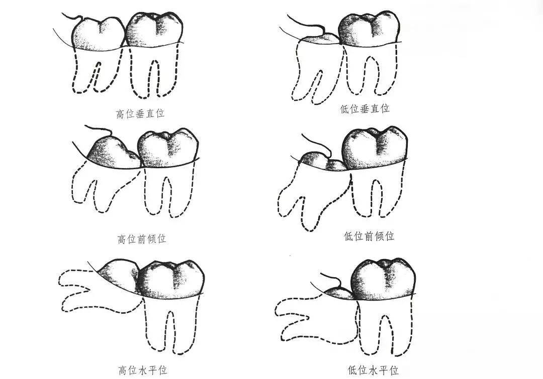 像上图的各种高位阻生智齿,牙冠,牙根,邻牙没什么阻力的,通常用挺出