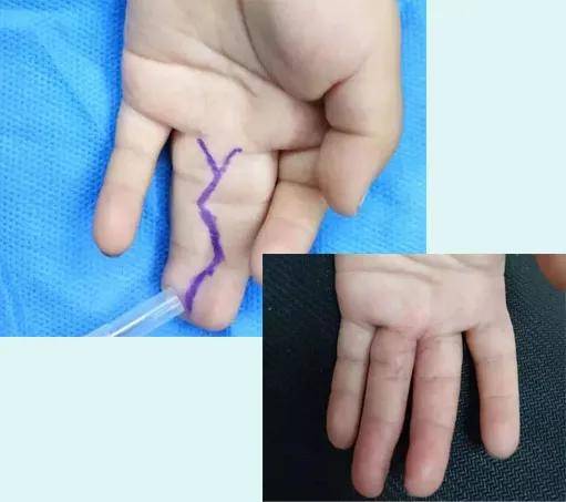 畸形|还能矫正吗？宝宝因为多了一根手指被嘲笑？多指畸形