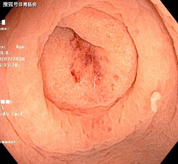 大家怎么治疗阑尾炎 817edf96e0594ca0ac072e1afbaf6da1.jpeg