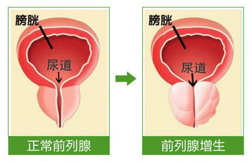 尿分叉是怎么回事?当心前列腺发福,前列腺增生的治疗方法