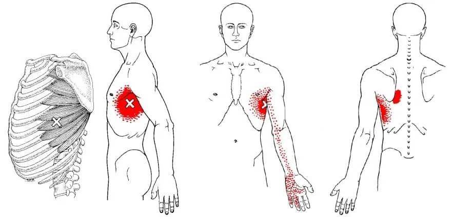 疼痛区域两拇指大小,主要表现的症状为疼痛发生在胸部中间水平前外侧