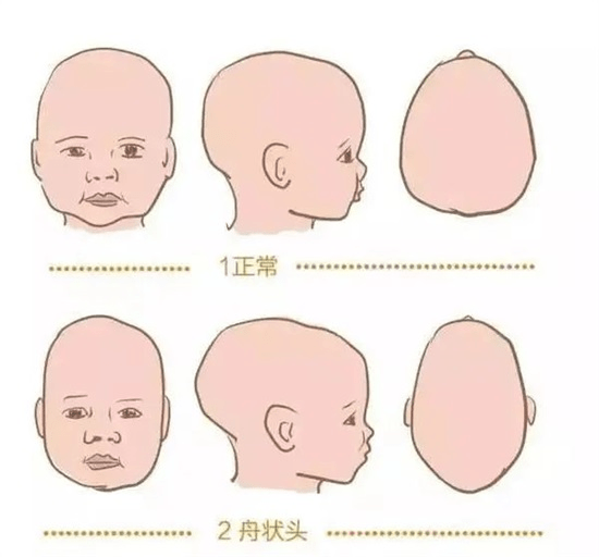 囟门闭合异常影响智力护理宝宝囟门一定要注意这3方面