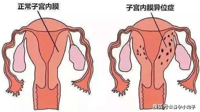 什么原因导致输卵管堵塞 22f46a78e0904a1e9c12f31c6c3ff279.jpeg