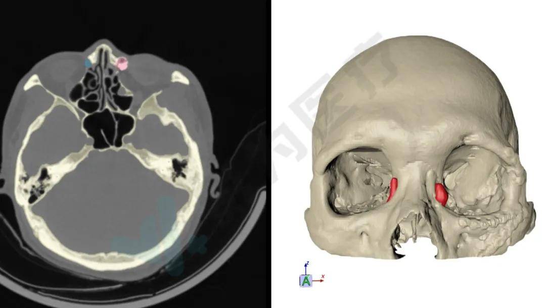 ct数据后,利用专用的术前规划软件, 重建老陈的头颅颅骨,泪囊及鼻泪管