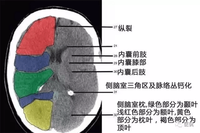 初学者必备:颅脑ct解剖口诀及彩色解剖图