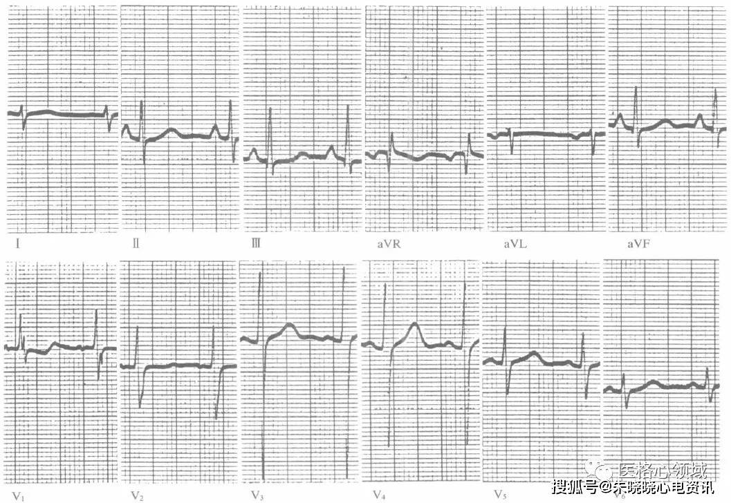 心室肥大,三种形态异常的qrs波不可忽视!_心电图