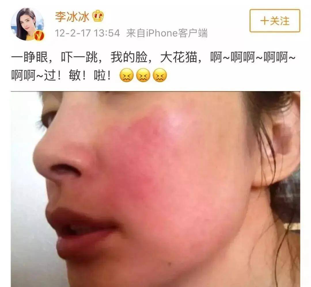 皮肤过敏好坑人,敏感夏季你是否也中了招?