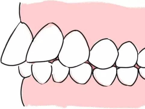 牙性龅牙 如果只是单纯的牙性龅牙,那么只有牙齿部位向前突出,上唇和