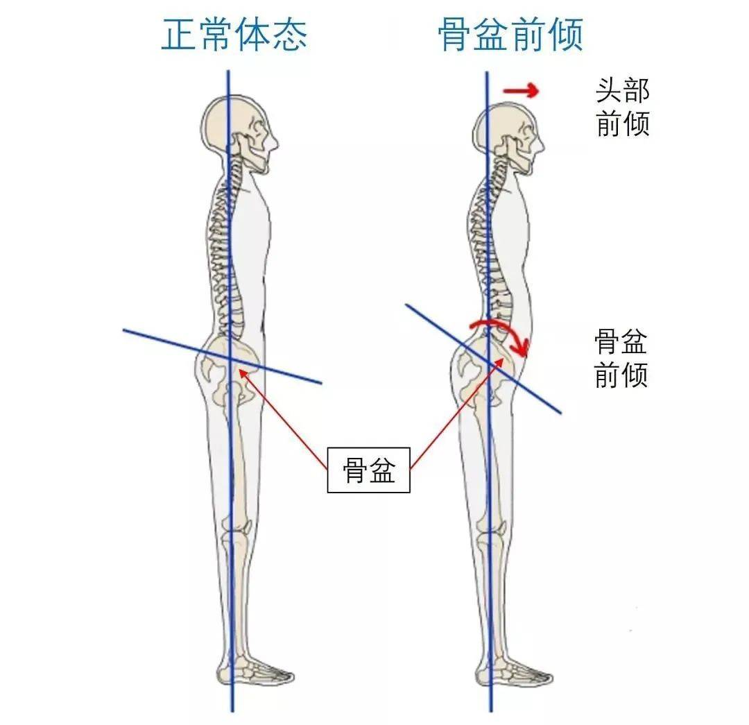 我们腰椎部分是有个向前弯的生理曲度,要是这个曲度过于向前凸,那就是