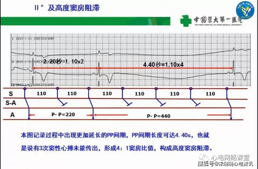 漫话心电:谈谈心电图的p波