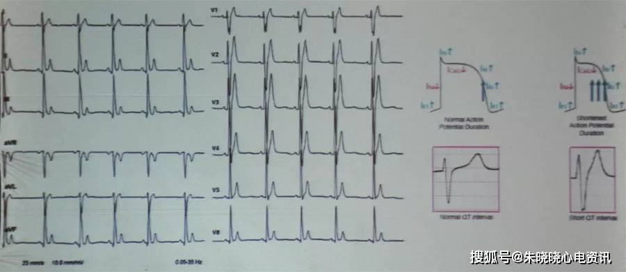 恶性心律失常的10种警示性心电图