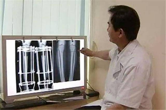 身高|现状如何？身体遭受的代价令人唏嘘曾花费16万断骨增高的李亚诺