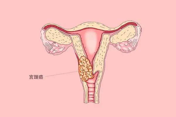 人口增长 指望 子宫(3)