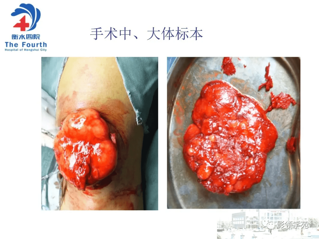 经典髌骨骨肿瘤及肿瘤样病变分析