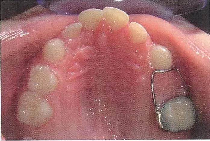 间隙保持器是什么儿童乳牙脱落治疗