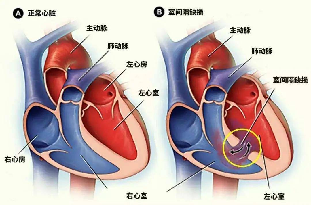 导致心脏病的第一个原因是什么 8ea8255f711a4baca311316b763f66c9.jpeg