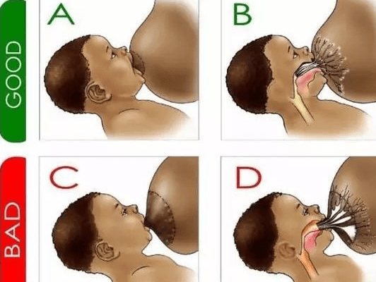 喂奶时|疼痛难忍？总结了以下经验，记得收藏！母乳喂养遭遇乳头皲裂