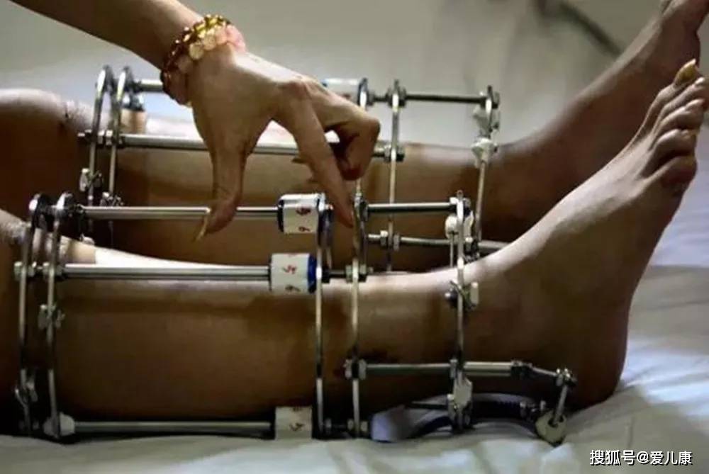 孩子|如今成了半残疾…这种「增高术」千万别给孩子做!当初花16万增高的孩子