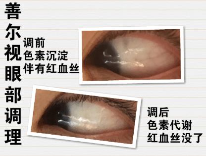 眼睛布满红血丝怎么办