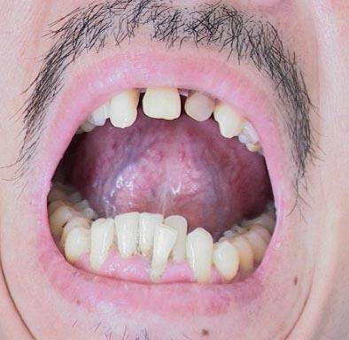 身体里有肿瘤,舌头上也会有表现!出现3种异象需小心