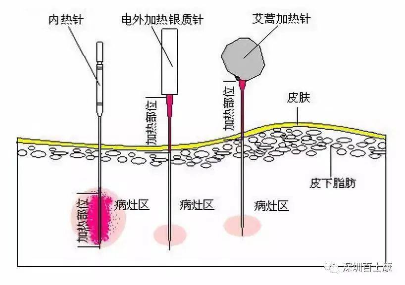 热烈祝贺平顶山市新华人民医院第二期内热针临床技术培训班圆满落幕