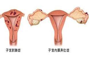 冻胚移植应该选择哪种子宫内膜准备方案?