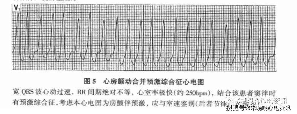 房颤时如果心室率极快(一般超过180bpm) 且qrs 波宽大畸形,必须考虑