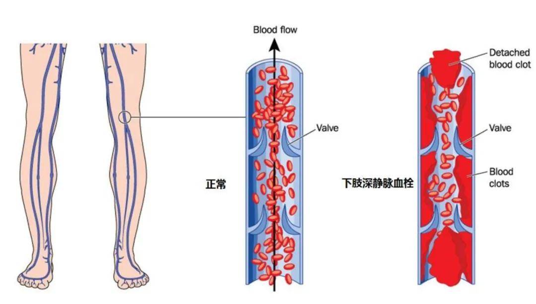 集美健康安静的健康杀手深静脉血栓