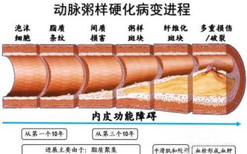 动脉粥样硬化是心脑血管疾病的根源!能被逆转吗?