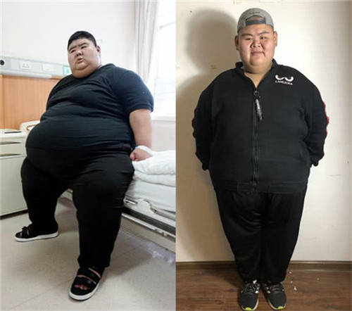 中国第一胖王浩楠:一年减掉363斤,变瘦后成功抱得美人