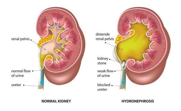 肾脏|上厕所时，尿液若呈现4个状态，或是尿毒症信号，千万别忽视！