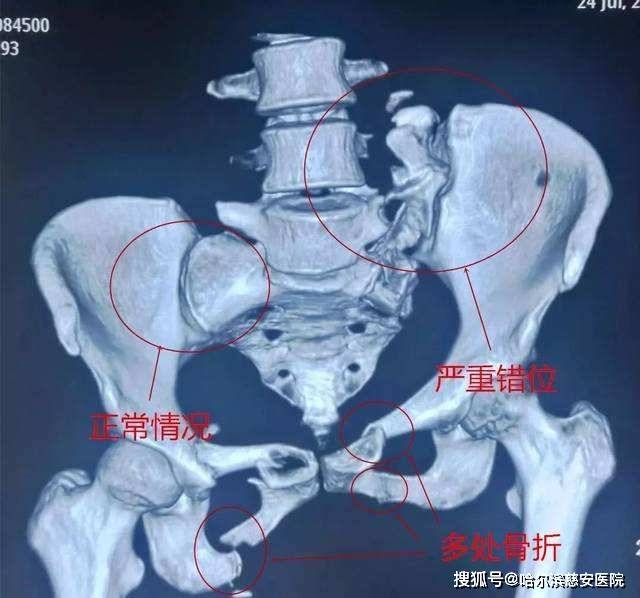 【专业科普】骨盆骨折的概念